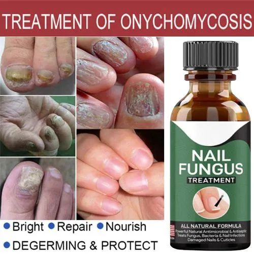 Nail Fungus Ka Khatma – Repair Serum Gel 30ml