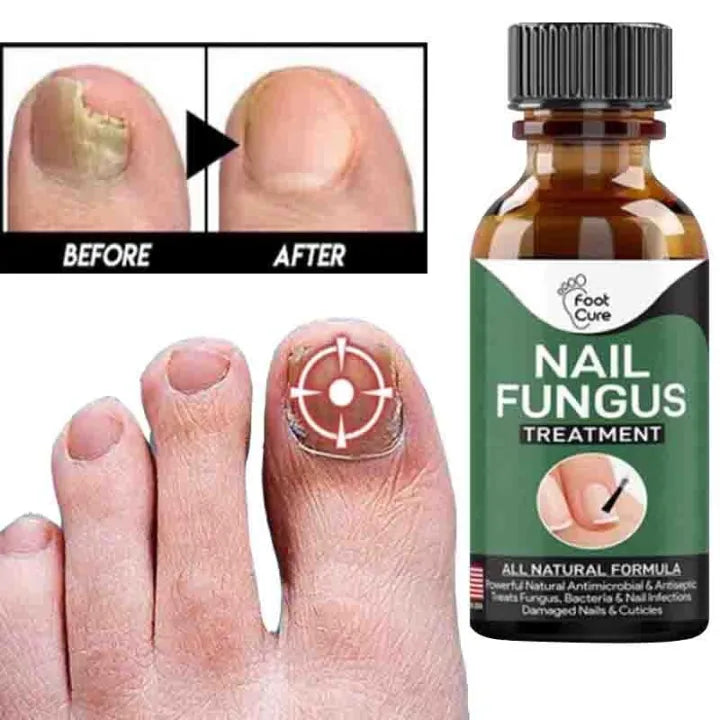 Nail Fungus Ka Khatma – Repair Serum Gel 30ml